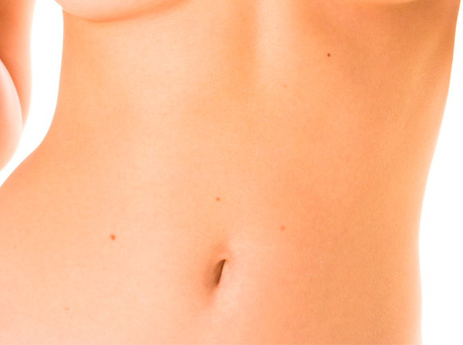 Abdominoplastia