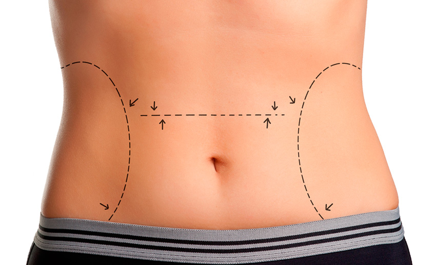 Lipoaspiração e Lipoescultura