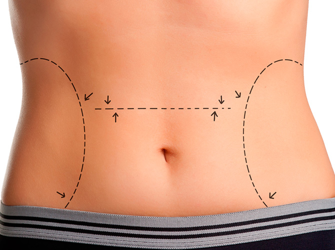 Lipoaspiração